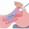 Vie Scope Laryngoskop VS133